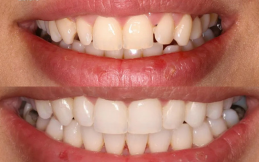 best Invisible Braces results in Islamabad
