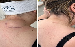 best Lipoma Treatment in Islamabad
