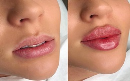 cost of lip reduction in Islamabad