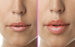 lip reducatiin before after