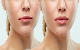lip-reduction in Islamabad