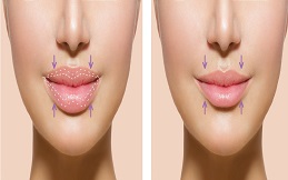 lip-reduction surgery in Islamabad