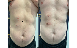 lipoma-before-after