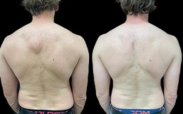 lipoma treatment -before-after