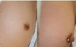 Areola Reduction before after results