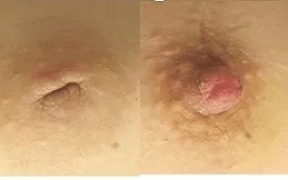 Areola Reduction before after