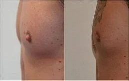 Areola Reduction cost in Islamabad