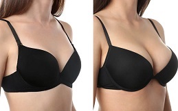 Best Breast Augmentation