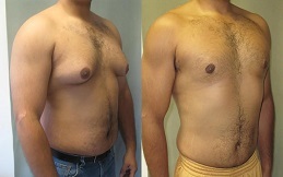 Best Gynecomastia surgery