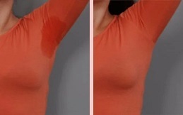 Botox for Sweaty Glands before after results