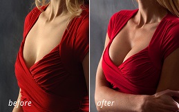 Breast Augmentation before after results
