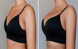 Breast Augmentation before after