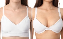 Breast Augmentation