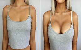 Breast Enlargement Injections before after