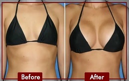 Breast Enlargement Injections