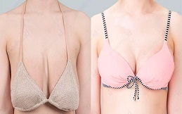 Breast Implants before after results