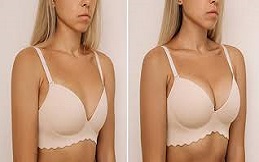 Breast Lift Surgery before after results
