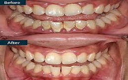 Gum Bleeding Treatment before after