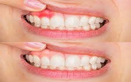 Gum Bleeding in Islamabad