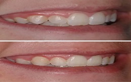 Gum Recontouring before after results