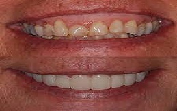 Gum Recontouring before after