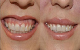 Gum Recontouring cost in Islamabad