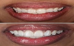 Gum Recontouring in Islamabad