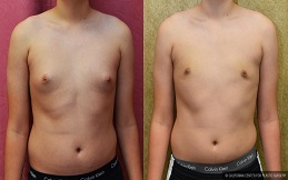 Gynecomastia before after results