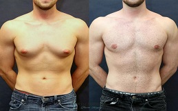 Gynecomastia before after