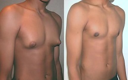 Gynecomastia cost in Islamabad