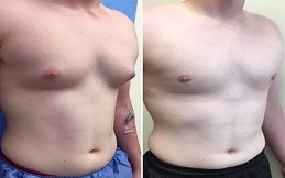 Gynecomastia surgery