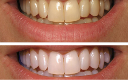 Teeth Whitening Strips before after results