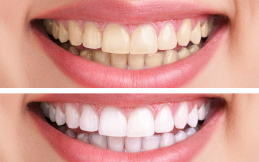 Teeth Whitening Strips in Pakistan