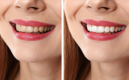 Teeth whitening strips