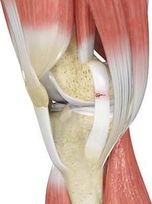 Multi-ligamentous Knee Surgery in Islamabad