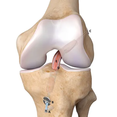 Anterior Cruciate Ligament Reconstruction in Islamabad
