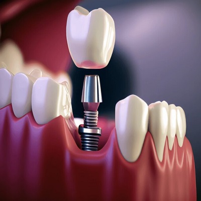 Dental implants in Islamabad