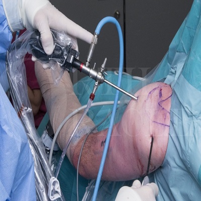 Subacromial Decompression in Islamabad