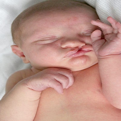 Cleft Lip Surgery in Islamabad