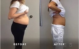 Mounjaro injections before after