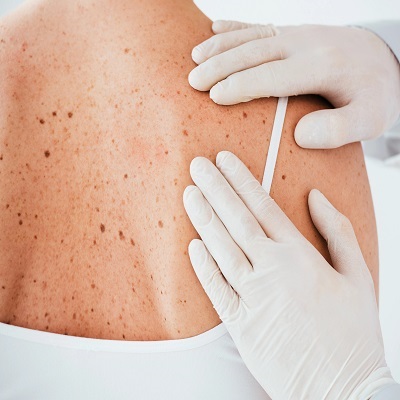 Seborrheic Keratosis Treatment in Islamabad
