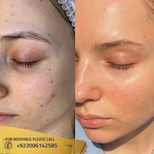 Hydrafacial Before After