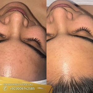 Hydrafacial Before After