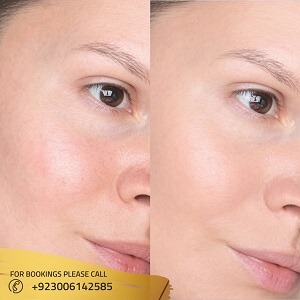 Hydrafacial Before After